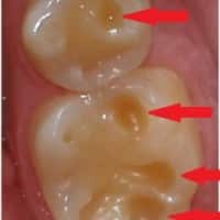 Acid Reflux Pitting Teeth