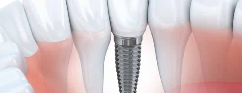How to care for dental implants