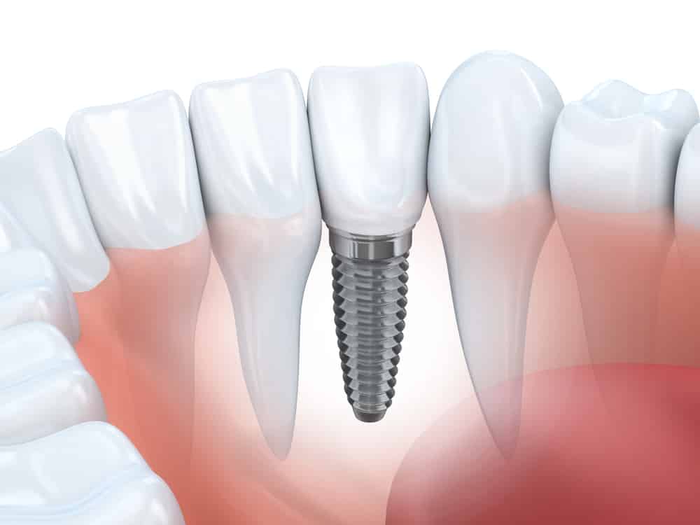How To Care For Dental Implants Australia Dental Clontarf